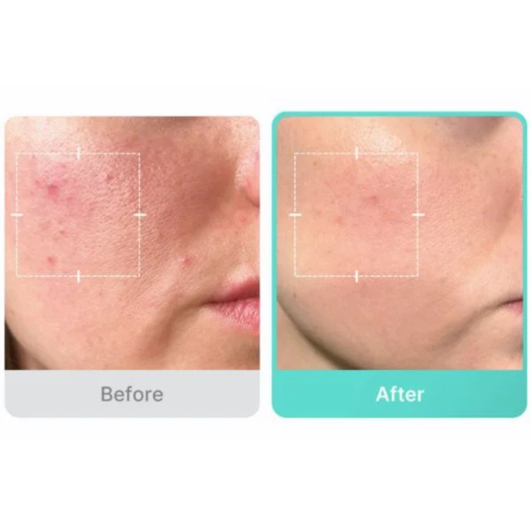Azelaic Acid 16 BB Calming Serum