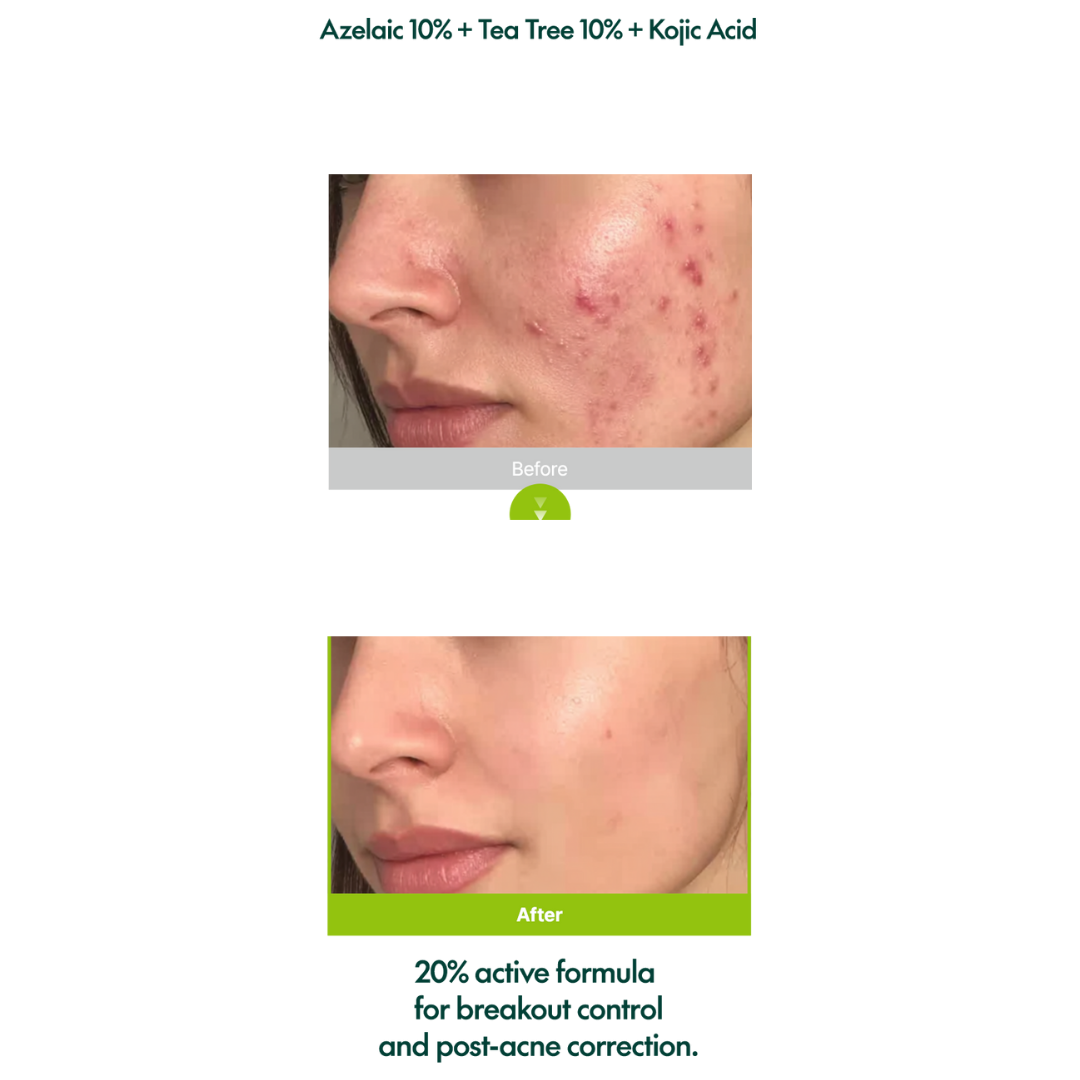 Azelaic Acid 10 Kojic Tea Tree Serum
