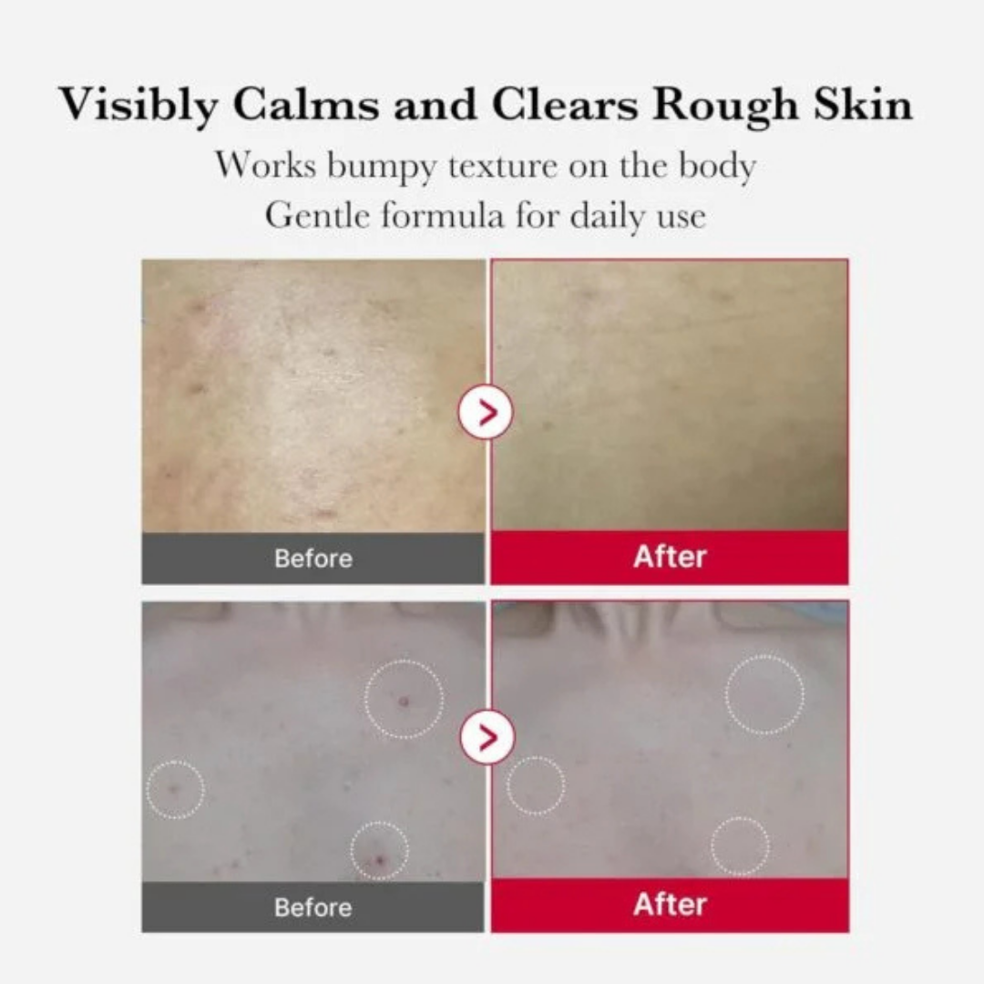 Red Acne Body Peeling Shot