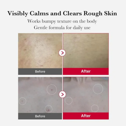 Red Acne Body Peeling Shot