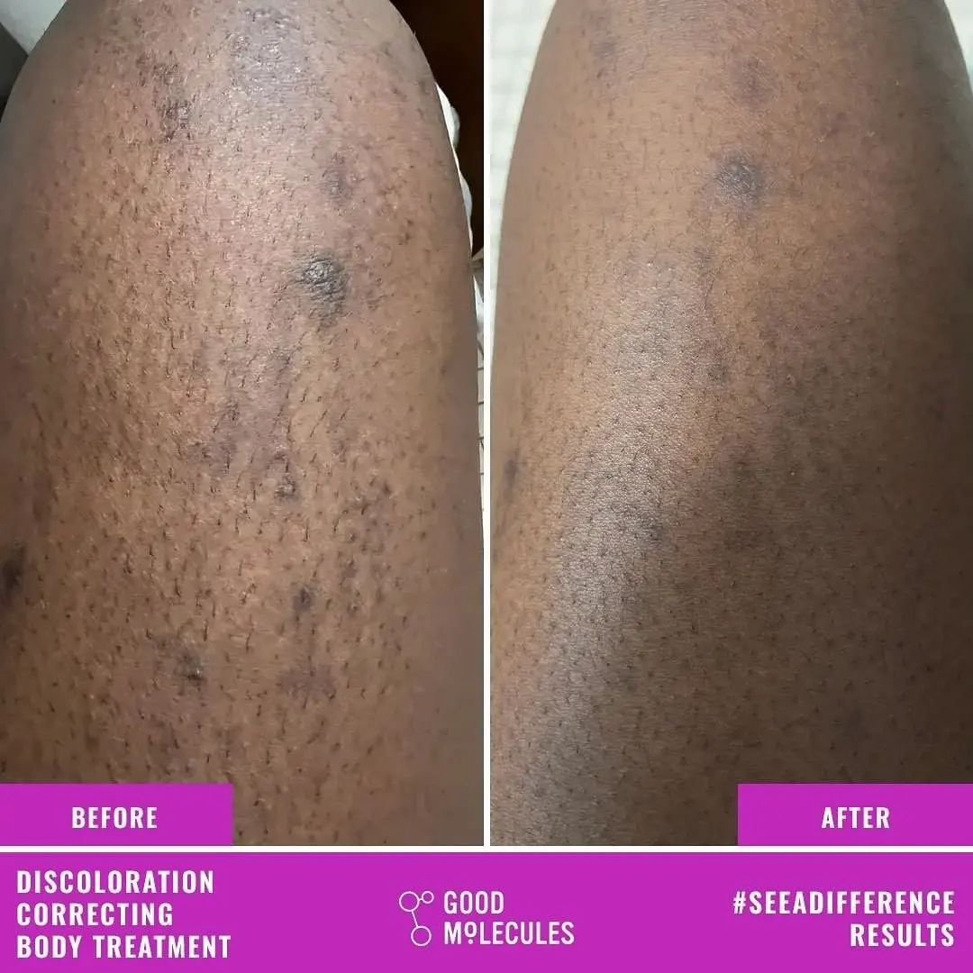 Discoloration Correcting Body Treatment
